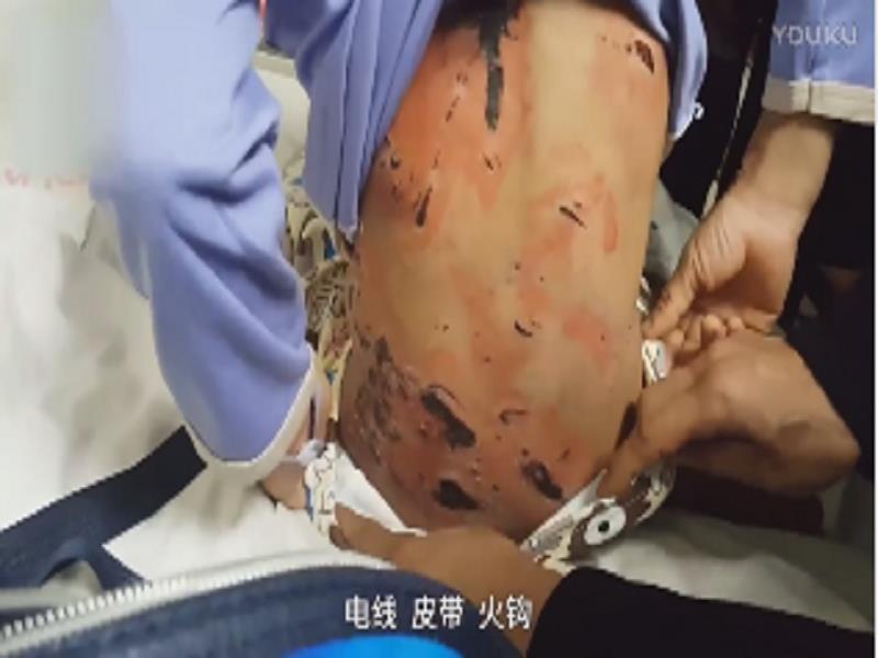 留守男孩被姑父虐待抽打,全身都是伤疤